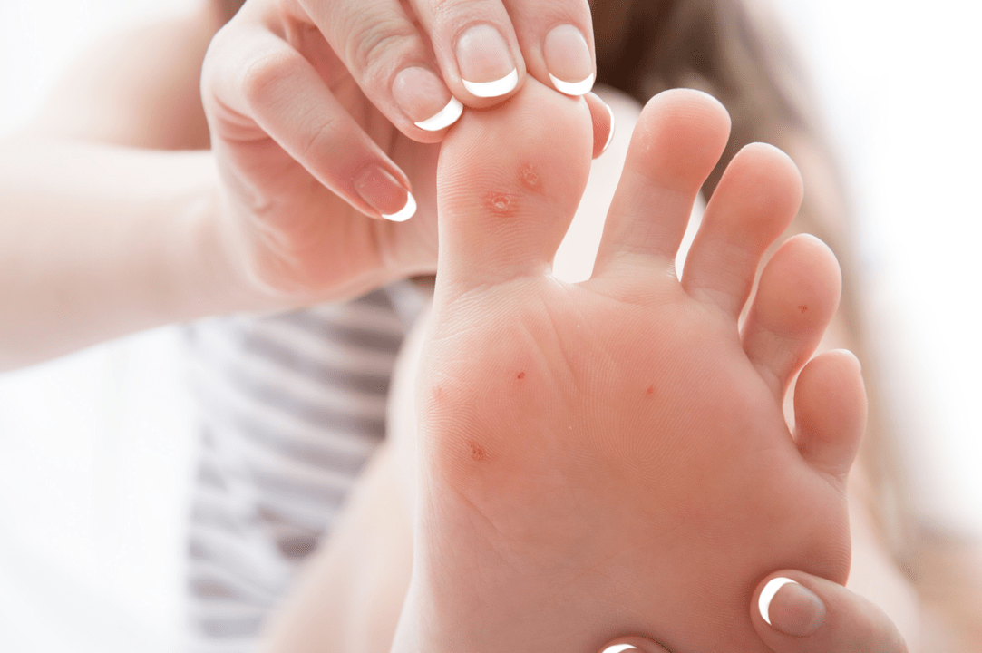 plantar wart on the foot