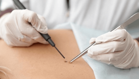 Characteristics of the removal of the papilloma