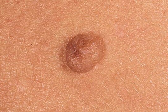 Simple papilloma