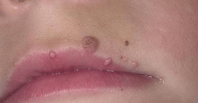 Papillomes on the lips
