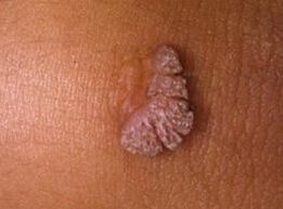 human papillomavirus what is it