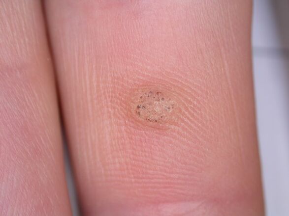 warts can cause cancer
