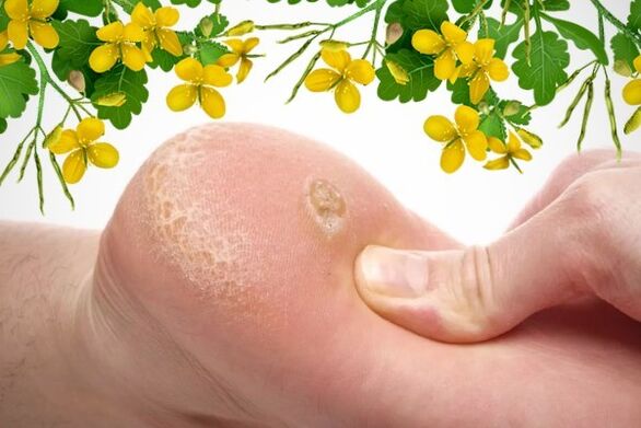 ways to cure warts