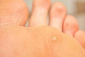 Why plantar warts appear