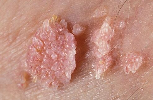 what genital papillomas look like